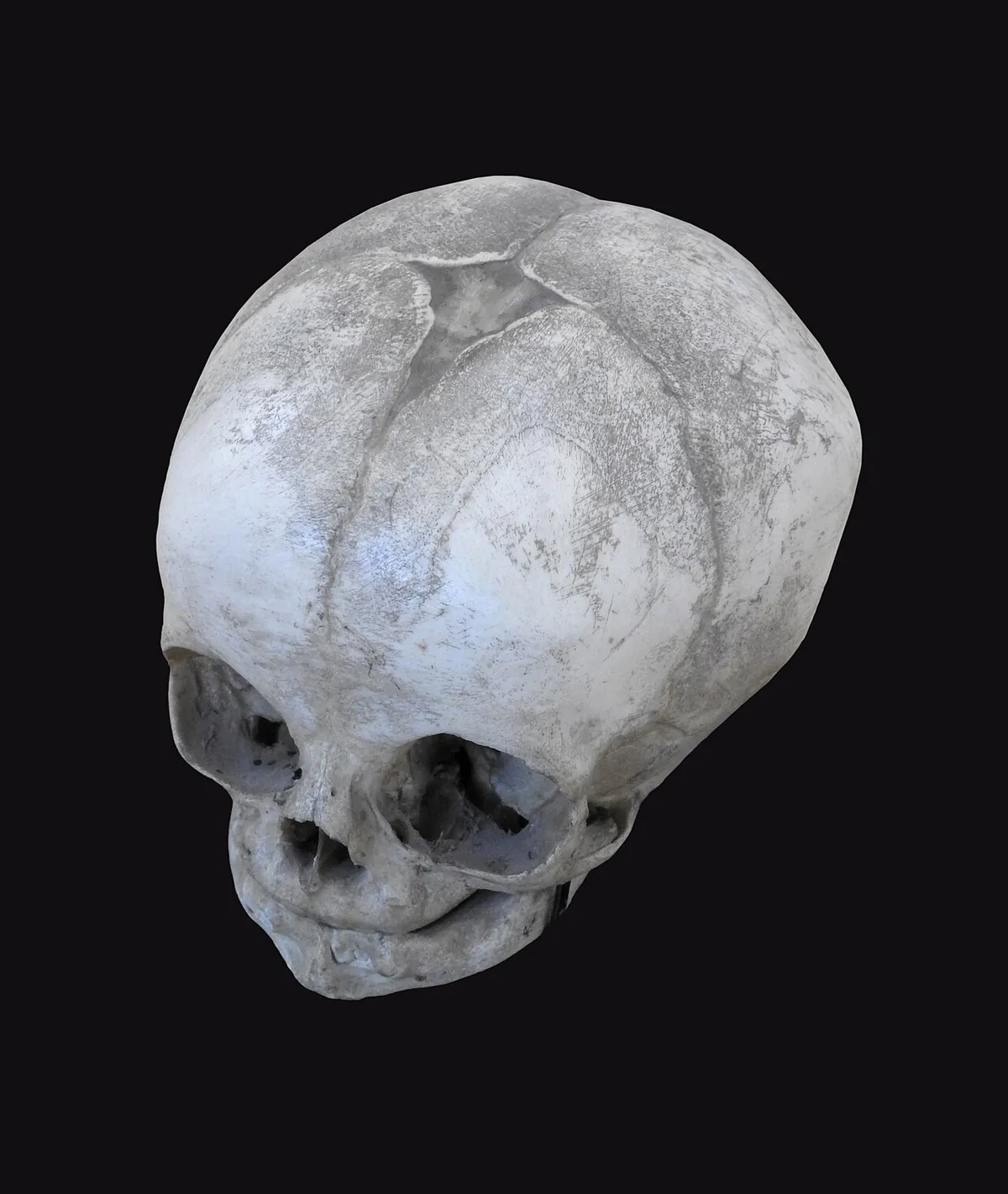 A baby's skull seen from above, with the soft spot visible between the bones